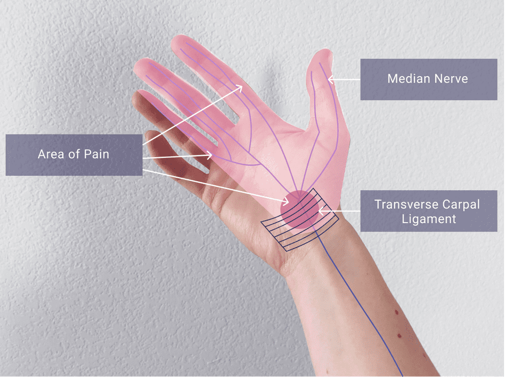 What's Causing Carpal Tunnel Syndrome and How to Prevent It. | Blog